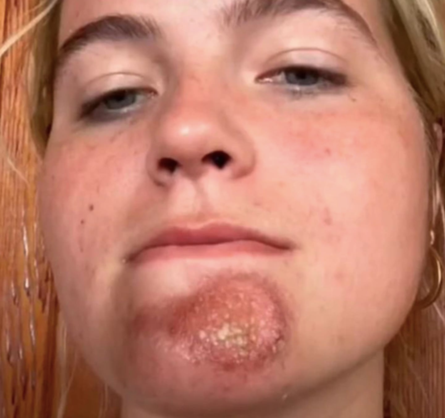 Hannah developed blisters and painful red sores. Photo / TikTok