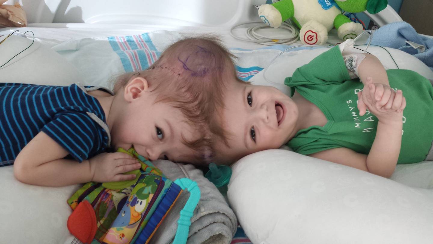 Conjoined twins, Jadon and Anias McDonald, bond after surgery NZ Herald