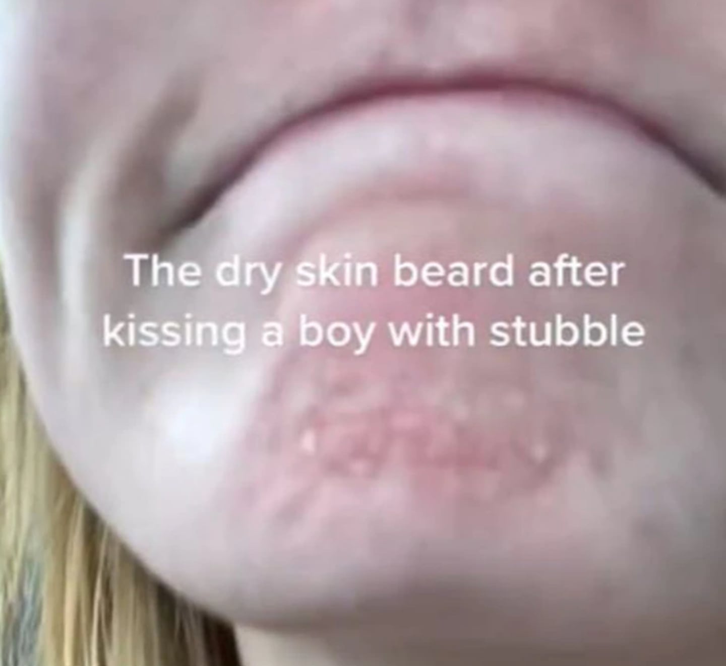 A TikTok video showing the dry, flaking skin women get after kissing men with stubble prompted one woman to share her horror pash story. Photo / TikTok