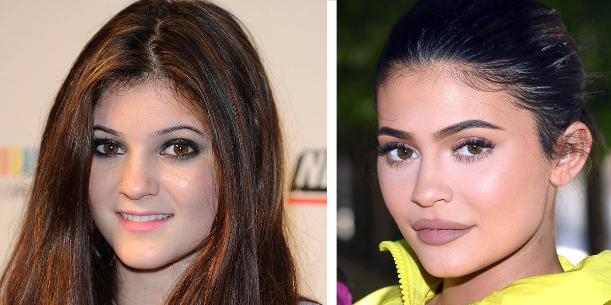 Kylie Jenner Before And After Surgery Yve 652 9511