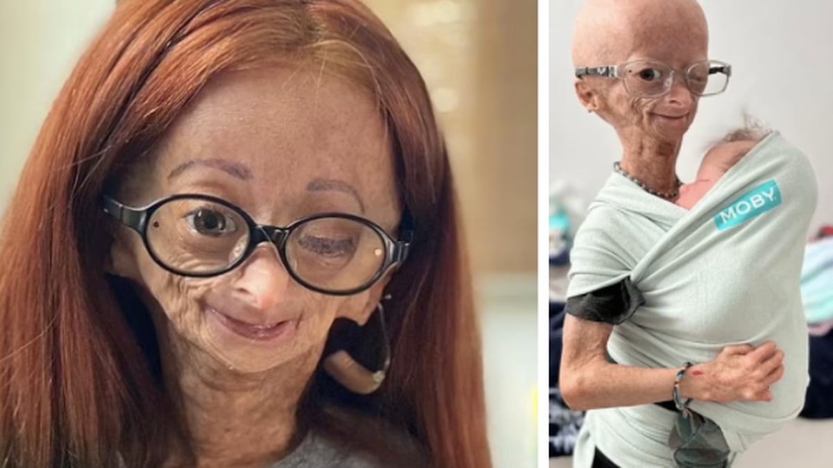 YouTuber Adalia Rose, która walczyła z progerią, umiera w wieku 15 lat: „Już nie boli”