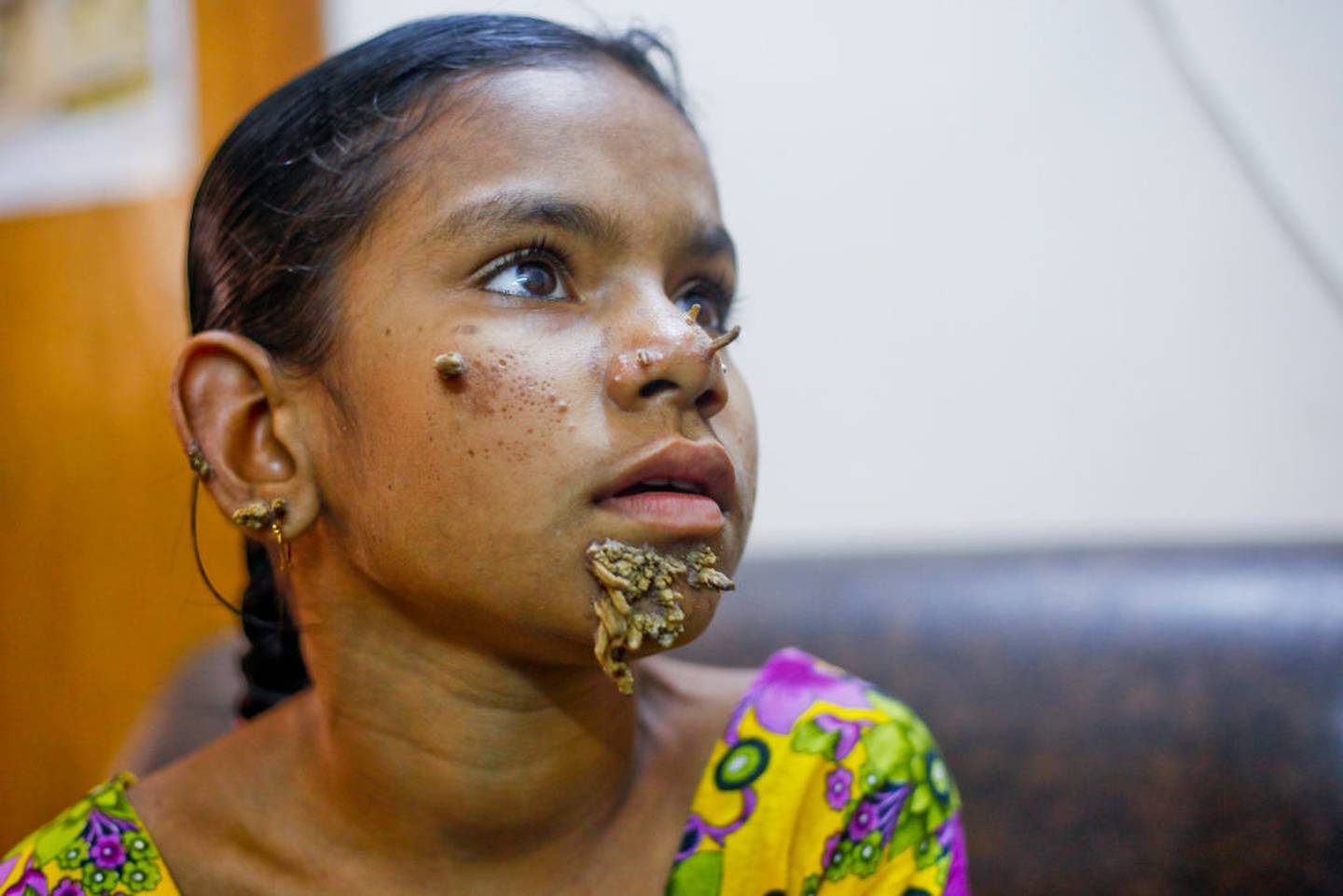 Bangladeshs Tree Man Begs Doctors To Amputate His Hands Nz Herald 