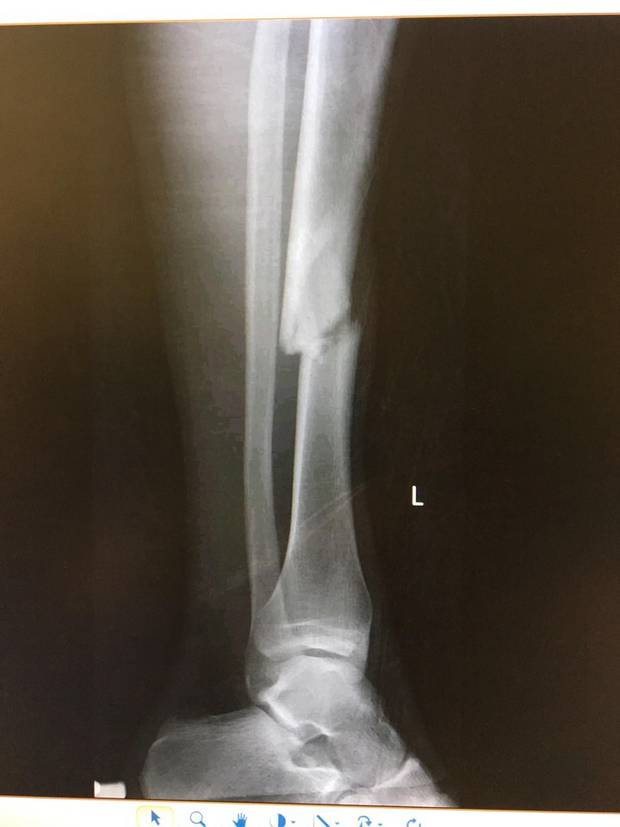 X-rays show the serious breaks in Dylan's leg. Photo / Supplied
