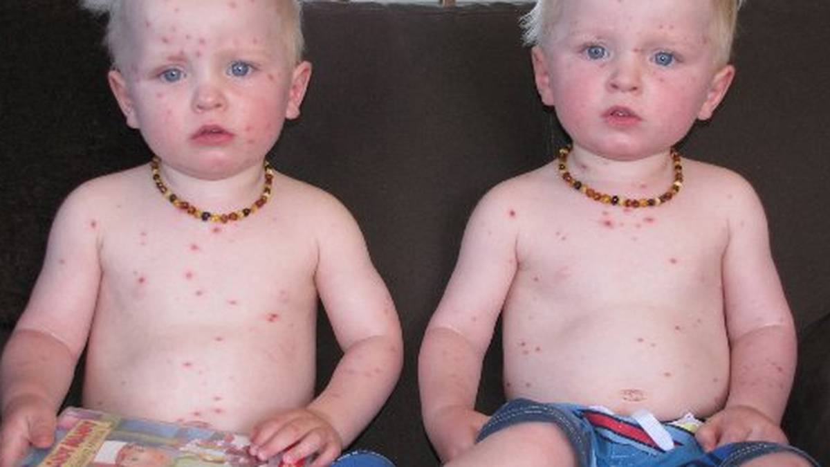 Chicken pox outbreak in Wanaka NZ Herald