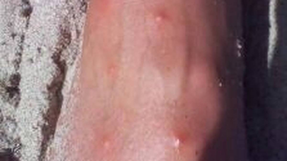 sand flea bites on feet